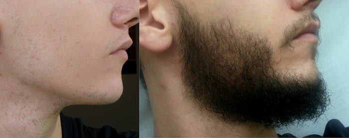 minoxidil beard before and after