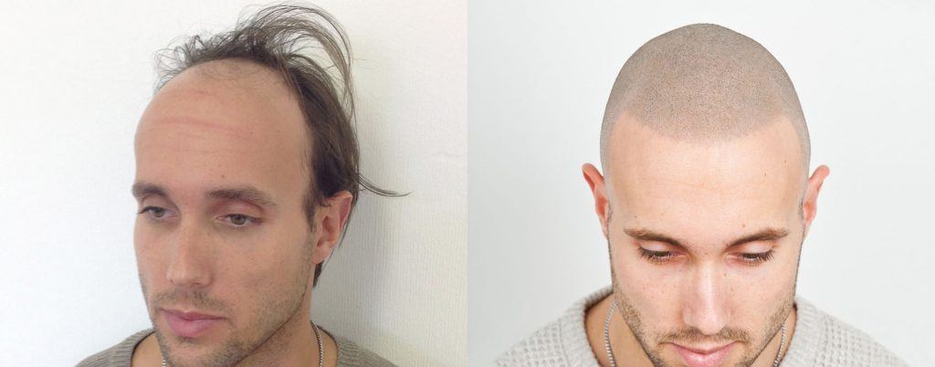 scalp micropigmentation before after 1