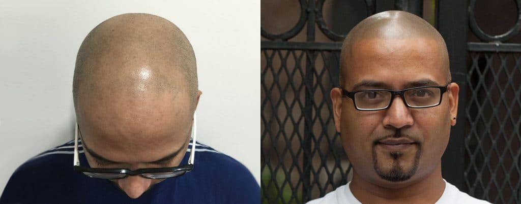 scalp micropigmentation before after 2