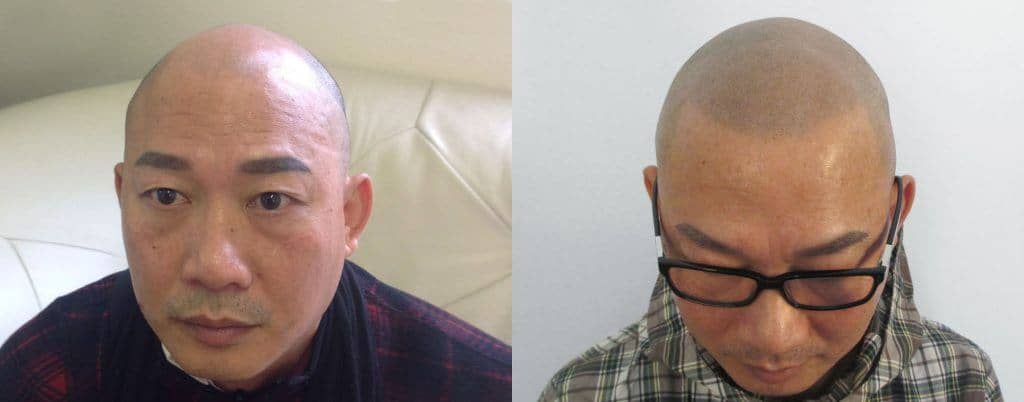 scalp micropigmentation before after 3