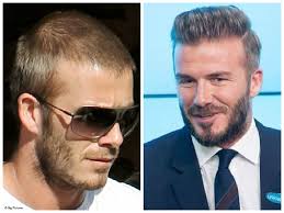 David Beckham hair transplant