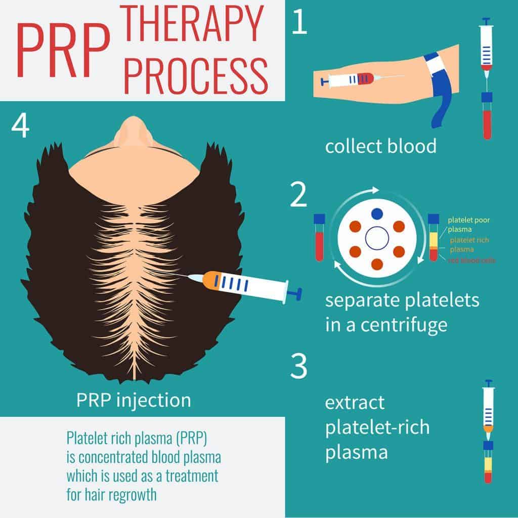 prp platelet rich plasma treatment